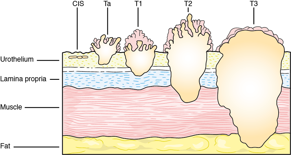 What Is High Grade Bladder Cancer