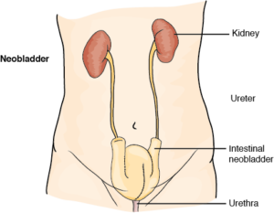 Diagram of what a neobladder looks like.   This is sometimes done after a radical cystectomy, or bladder removal. 