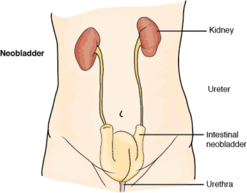 Radical Cystectomy Bladder Removal Surgery