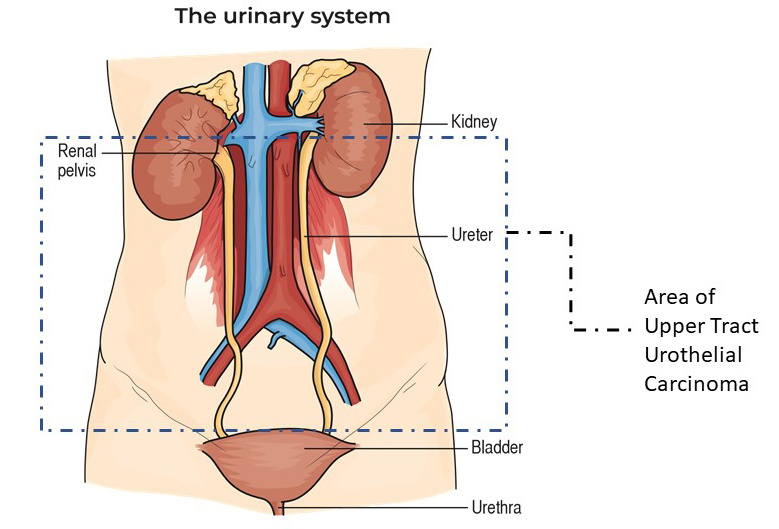 This is an image about where upper tract urothelial carcinoma can appear in the body.