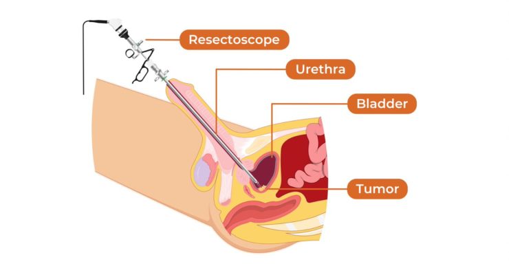 Image of resectoscope used in transurethral resection of bladder tumor