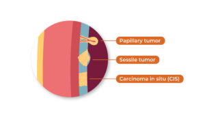 Papillary, sessile and carcinoma in situ image