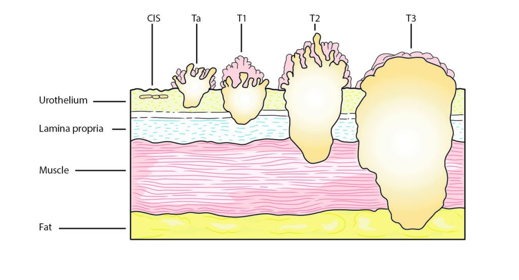 Bladder Cancer Types, Stages, & Bladder Cancer Grades