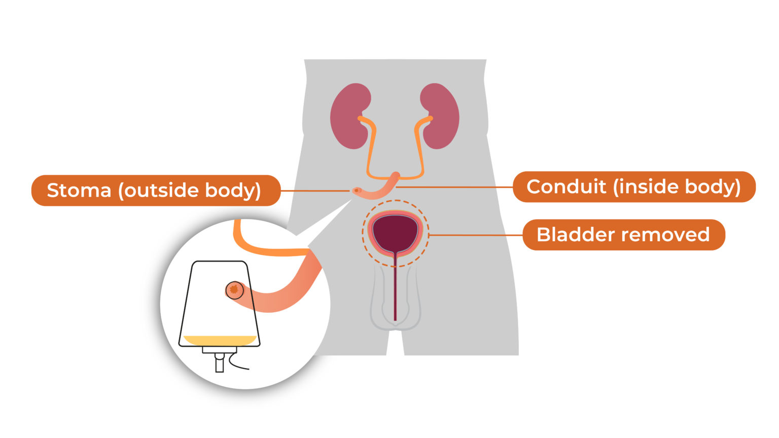 Urinary Diversion What Is It? What Are My Options? BCAN