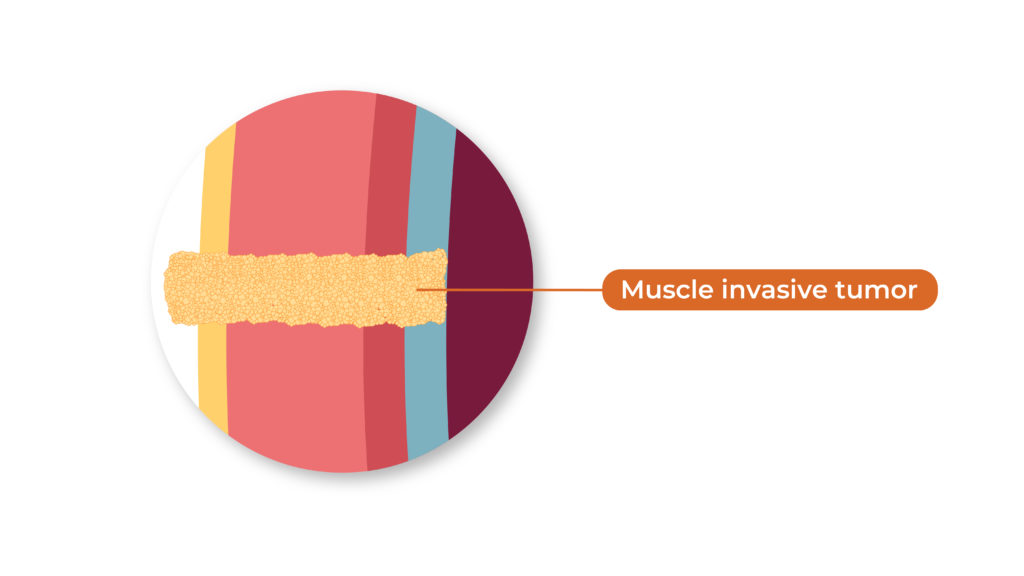 This is an illustration of muscle invasive bladder cancer, when the tumor grows beyond the lining of the bladder.